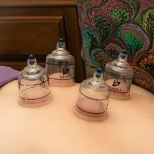 cupping treatment